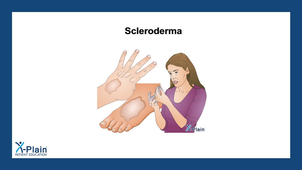 Scleroderma