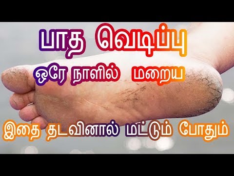 Home Remedies For Cracked Feet/Heels In Tamil - பாத வெடிப்புகள் மறைய Foot Crack -Tamil Beauty Tips