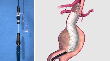 EVAR of Abdominal Aortic Aneurysm
