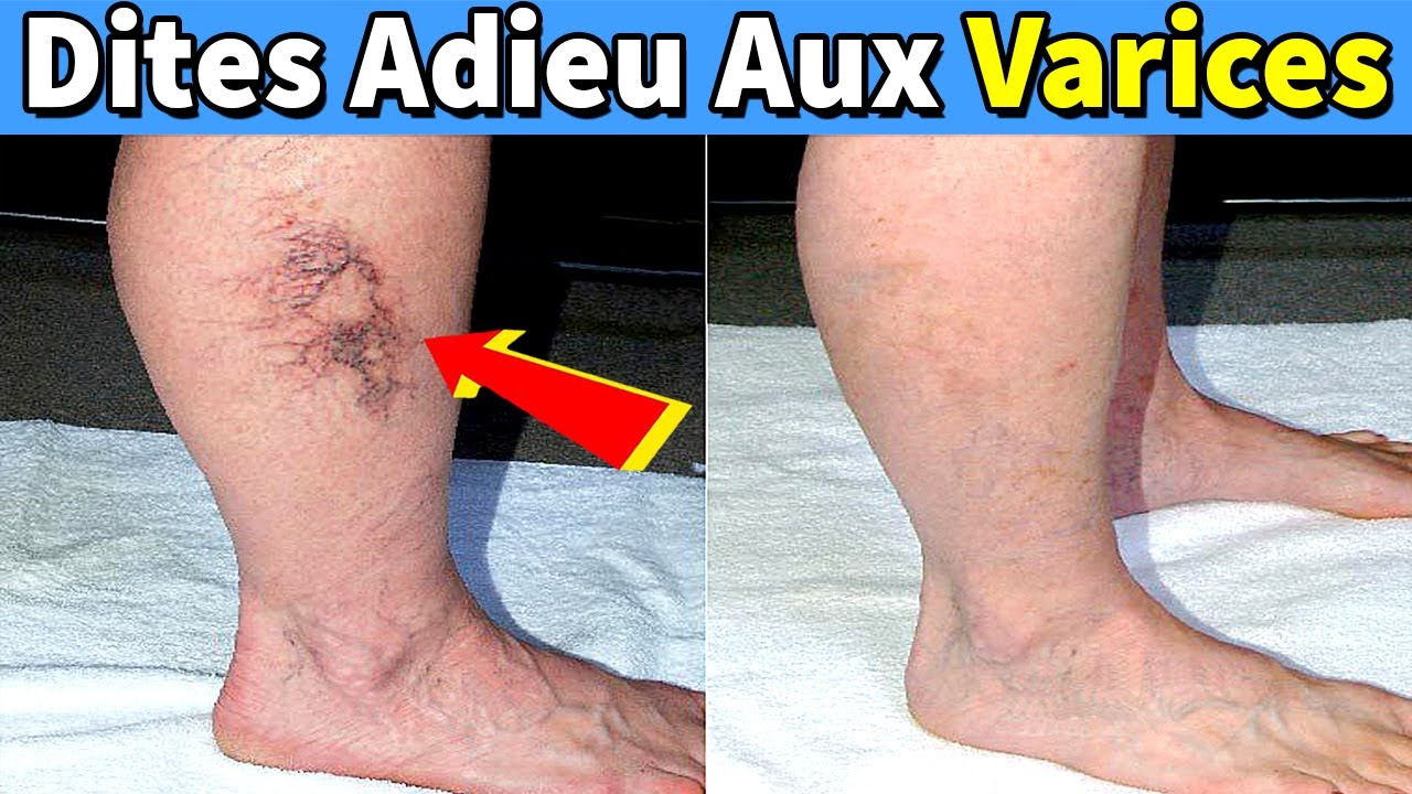 Buvez-Le Tous Les Jours Et Dites Adieu Aux Varices