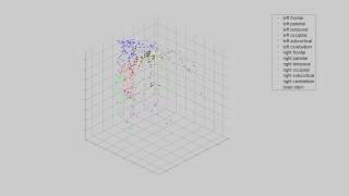 Isomap on 7 patients using Nonlinear dimensionality reduction toolbox