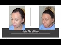 Lowering the Overly High Hairline in Women and Men