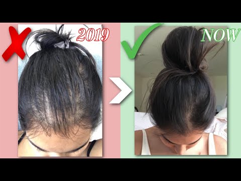 HOW I GREW MY HAIR BACK NATURALLY | Qu0026A, BEFORE U0026 AFTERS, HAIR LOSS STORY | RESULTS IN JUST 1 MONTH