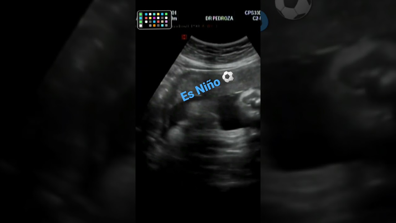 Cómo saber si es niño 