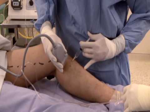 laser treatment for spider veins side effects laser treatment for spider veins side effects