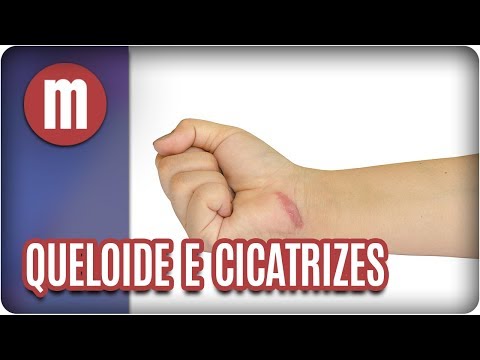 Vídeo: Coceira Na Cicatriz: Causas, Tratamentos E Prevenção