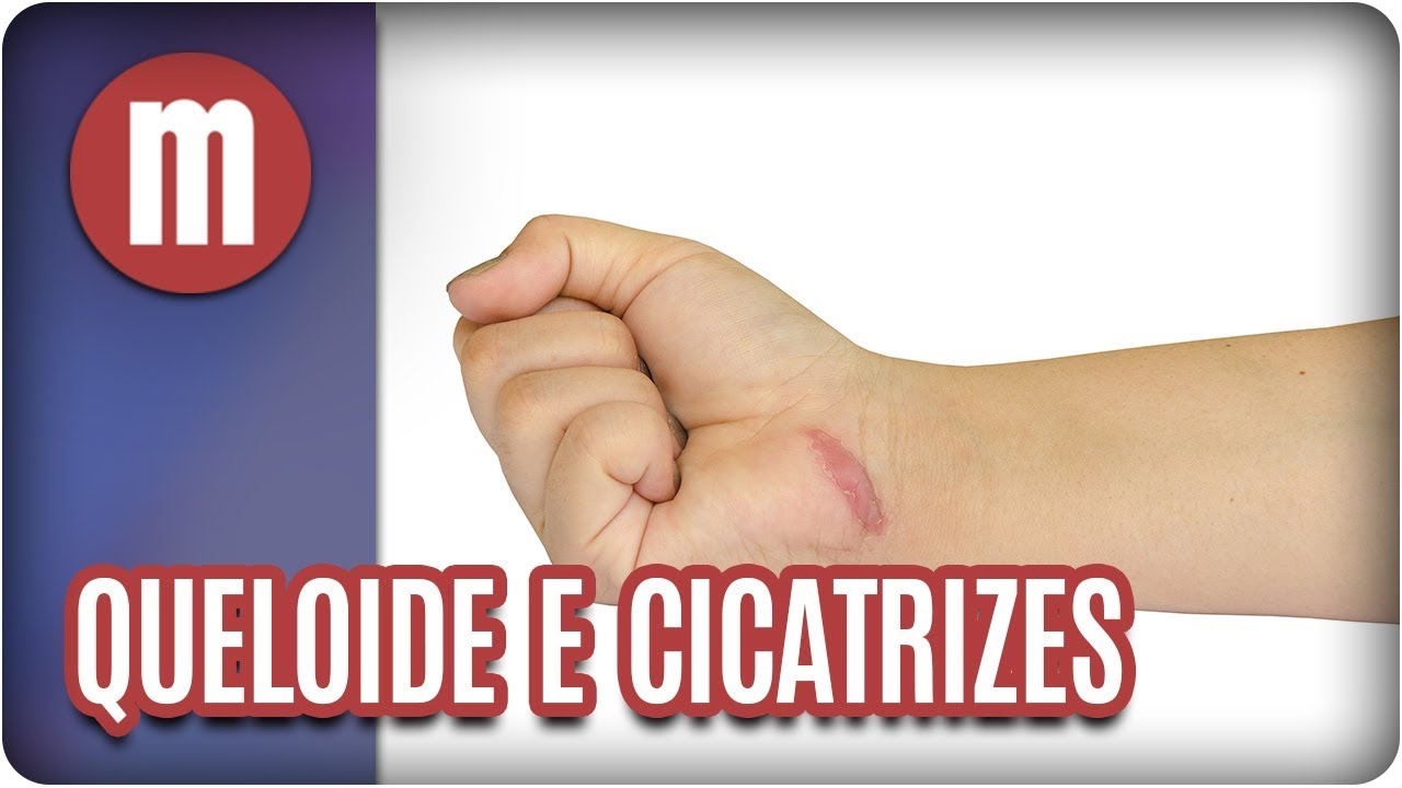 Queloide e cicatrizes hipertróficas - Mulheres (01/09/17)