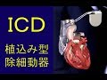 不整脈の治療 ICD (植込み型除細動器）