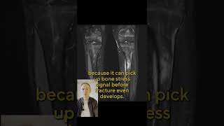 Stress Fracture vs Clean Break: What X-rays and MRIs Really Show