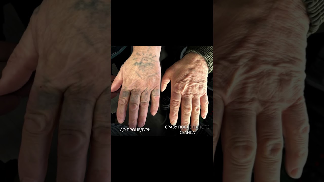 #удалениетату #tattooremoval