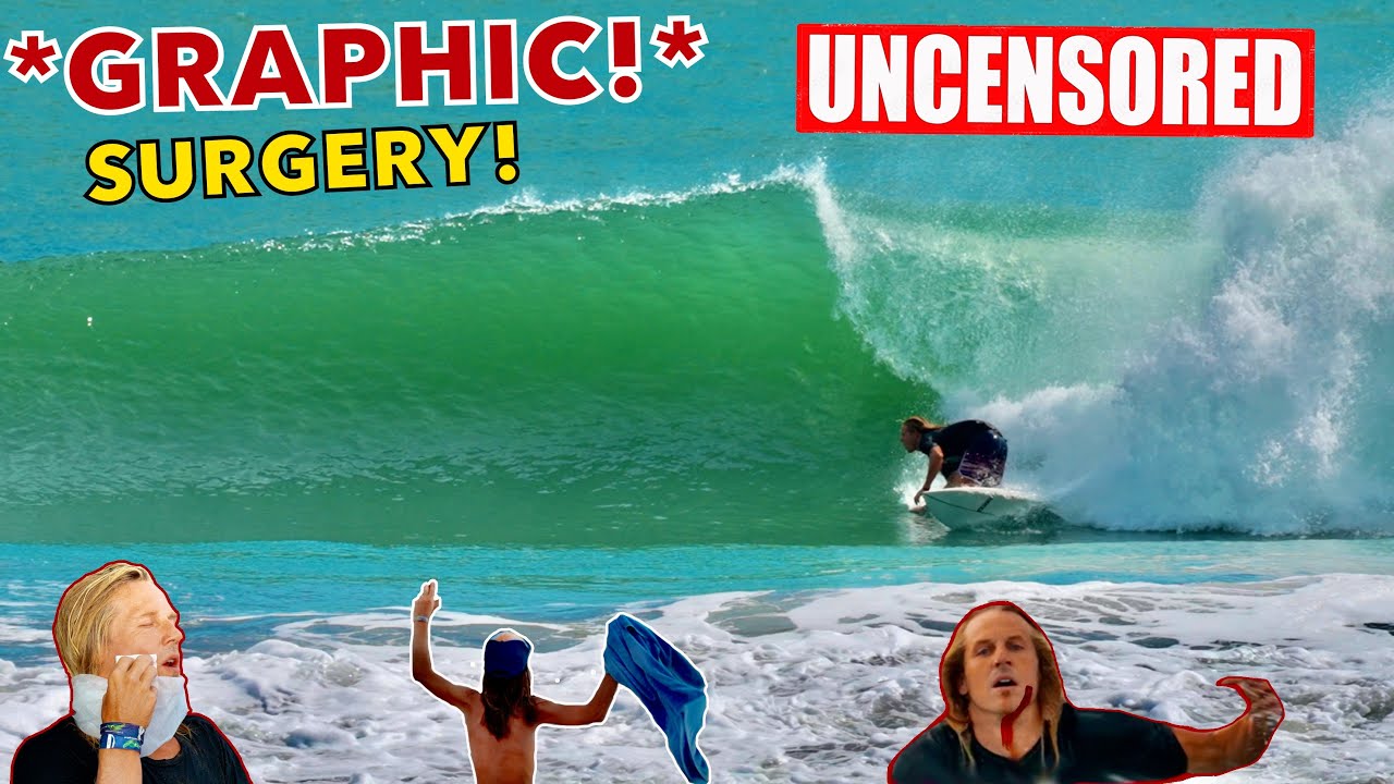 My Surfboard WENT THROUGH MY FACE! (*GRAPHIC 10 STITCHES UNCENSORED!*)