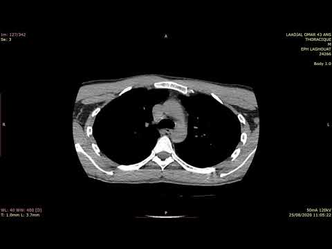 fenetre parenchymateuse pulmonaire