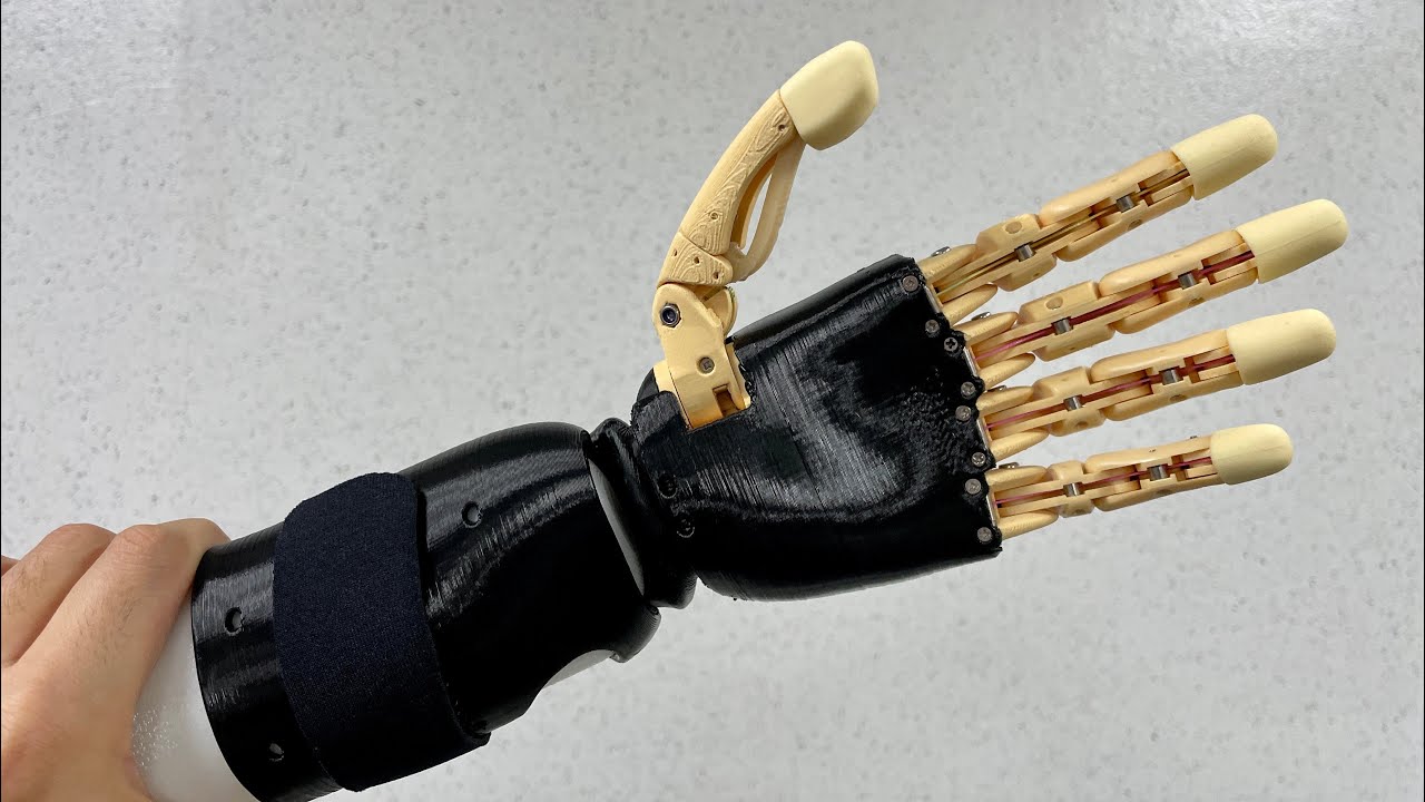 Mand.ro Hand Mark 5 for Wrist Disarticulation Case (2023.08.08) - YouTube