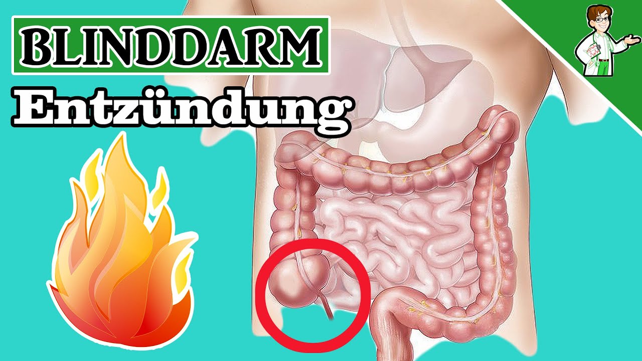 Wie Fühlt Sich Eine Blinddarmentzündung An www.youtube.com