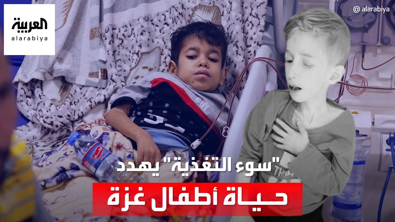 حياة الأطفال في غزة مهددة بسبب ارتفاع معدلات سوء التغذية
