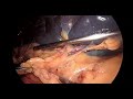 Does Size Always Matter? Giant Laparoscopic Splenectomy Without a Stapler | Technical Pearls