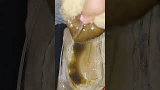 ayurvedic treatment panchkarma therapy#katibasti#backpaintreatment#sciaticapaintreatment