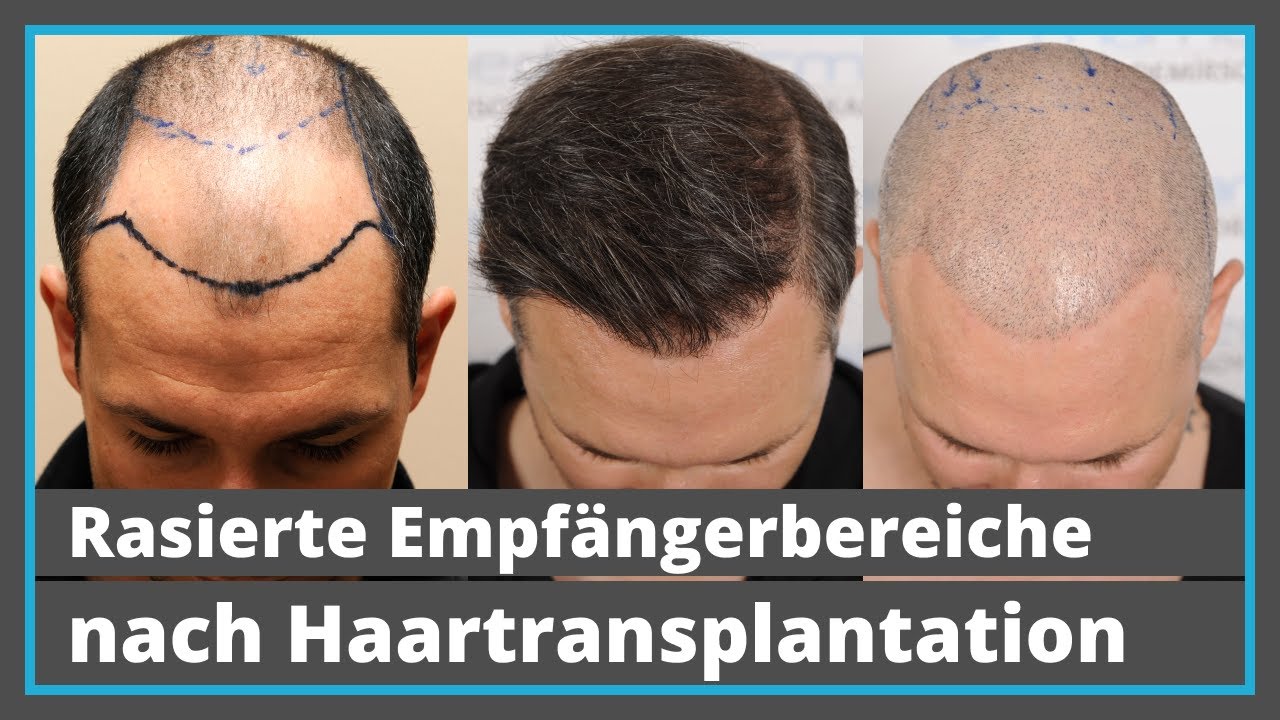 1 Jahr nach Haartransplantation: Ist eine Glatze noch möglich?