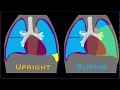 Pleural Effusion Explained by Prometheus Lionhart, MD