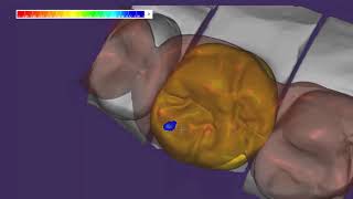 exocad Video Tutorial  Basic Features    Anatomic Coping with Cutback