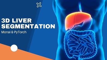 Automatic Liver Segmentation Using PyTorch and Monai
