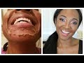 CHEMICAL PEEL Acne Results | Remove Dark Marks, Enlarged Pores & Wrinkles