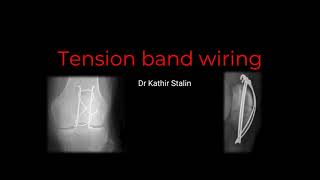 Basics of Tension Band Wiring in Orthopaedics: Guide for Medical Graduates - Dr Kathir Stalin