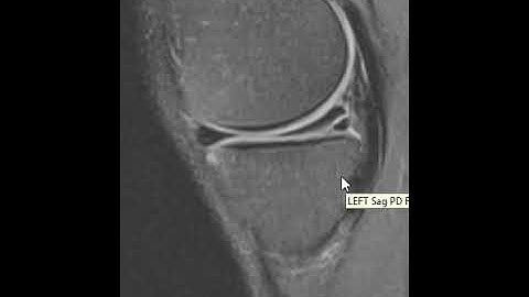 Knee MRI Scan of a Meniscus Tear | First Look MRI