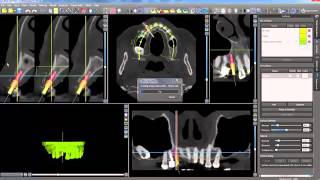 BSP Training Tutorial: Creating Holes for Implant Analogs in STL Model