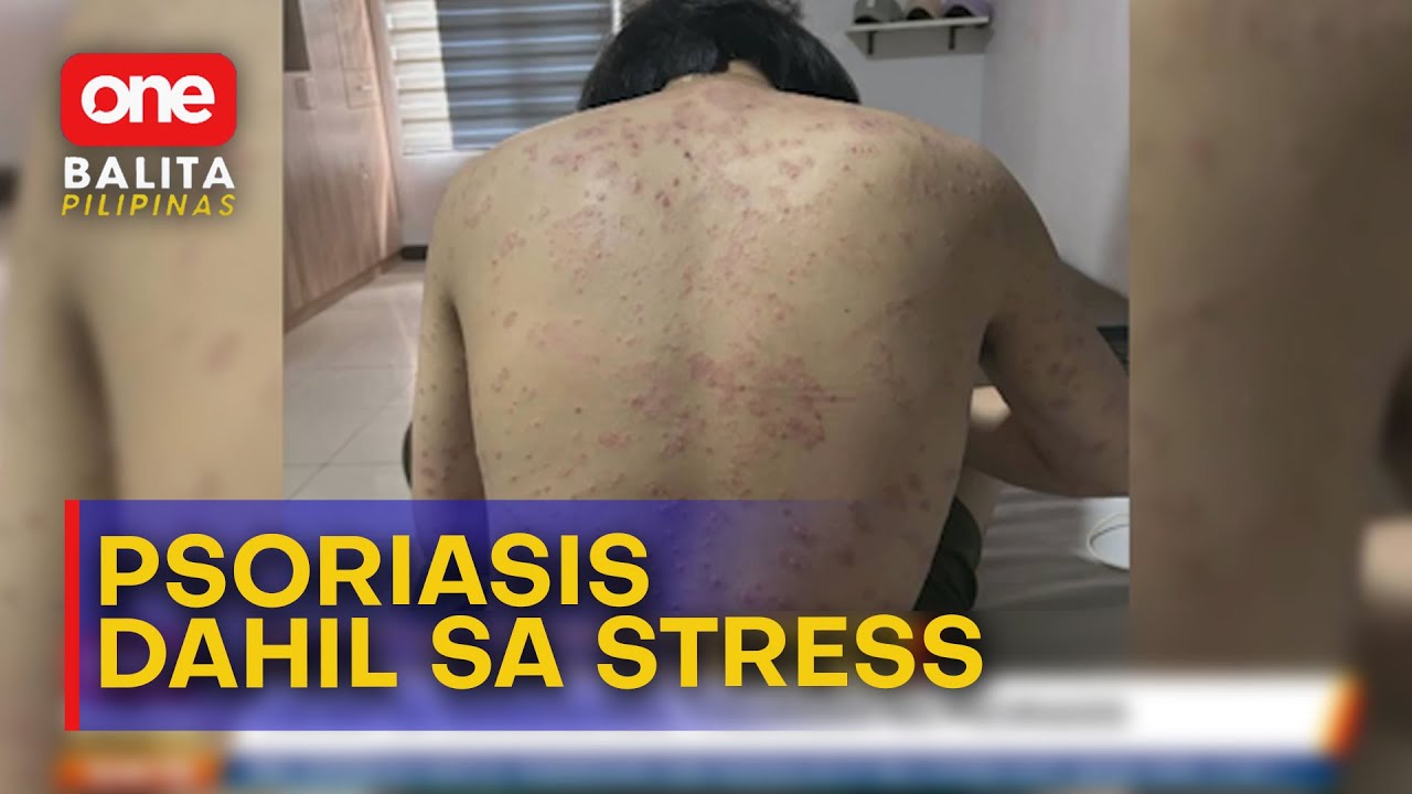 Lalaki sa Zamboanga, tinamaan ng psoriasis dahil umano sa stress sa trabaho | One Balita Pilipinas