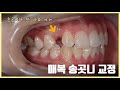 매복 송곳니 교정치료, 송곳니가 안 나요 / orthodontic treatment of impacted upper canine (maxillary canine exposure)