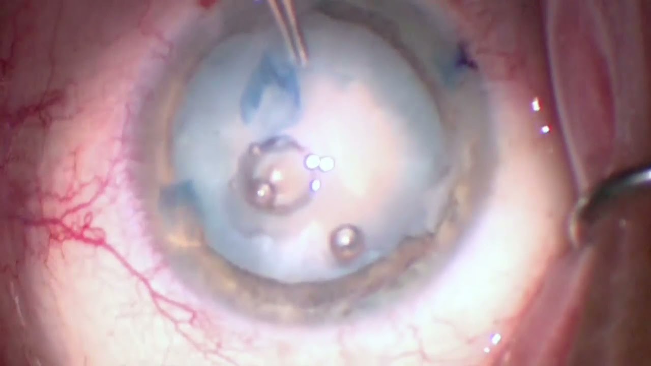 Flomax and Cataract Surgery - OCLI