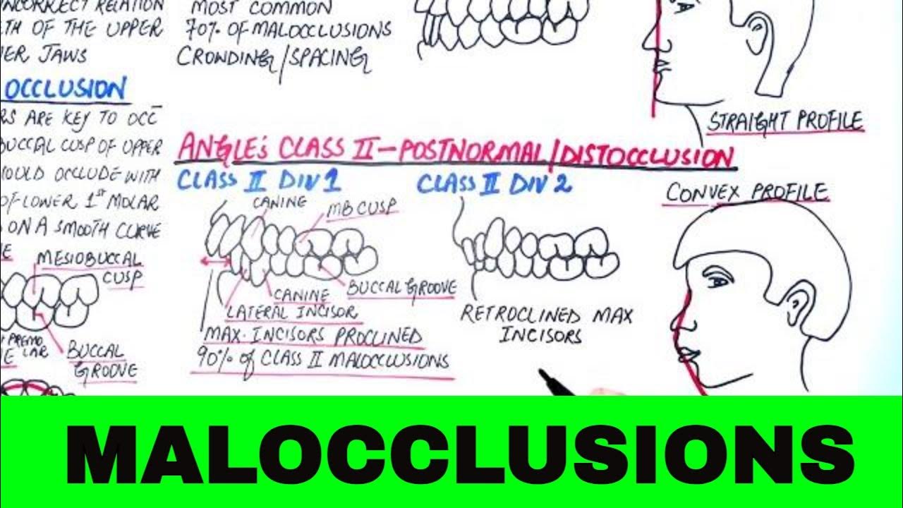 Angle s classification of malocclusion orthodontics youtube