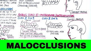 Angle's Classification of Malocclusion - Orthodontics