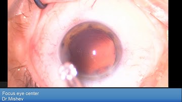 Oculentis LS313MF15 Comfort and Fuchs corneal dystrophy Lukan Mishev Live Stream