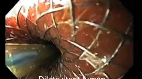 Hot AXIOS  drainage of a pseudocyst narrated  video SD