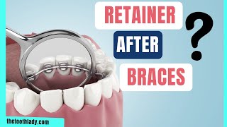 The Best Retainer After Braces by Dentalelle with Andrea 842 views 3 months ago 10 minutes, 4 seconds