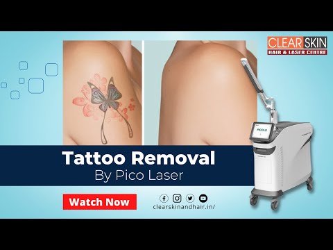 Tattoo Removal Clinics in Kurnool Andhra Pradesh  India