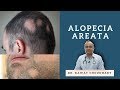 बाल झड़ना | गंजापन | Alopecia Areata | Baldness | Best Homeopathic Treat