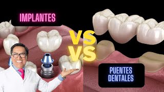 Las Prótesis dentales vs. Implantes