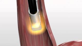 Barrx™ 90 Focal Ablation Catheter Animation Barrx Sizing Animation