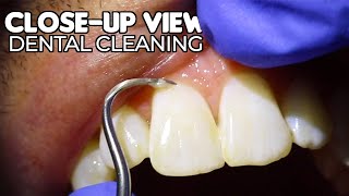 Dental Cleaning | Close-Up View (ASMR)