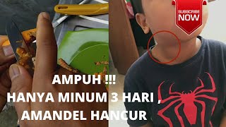 Obat Amandel Pada Anak, Herbal Untuk Amandel, Manfaat Kunyit Untuk Anak Amandel