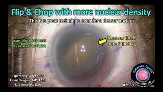 Cataractcoach 2689 Flip Chop Technique For Cataracts With More Nuclear Density