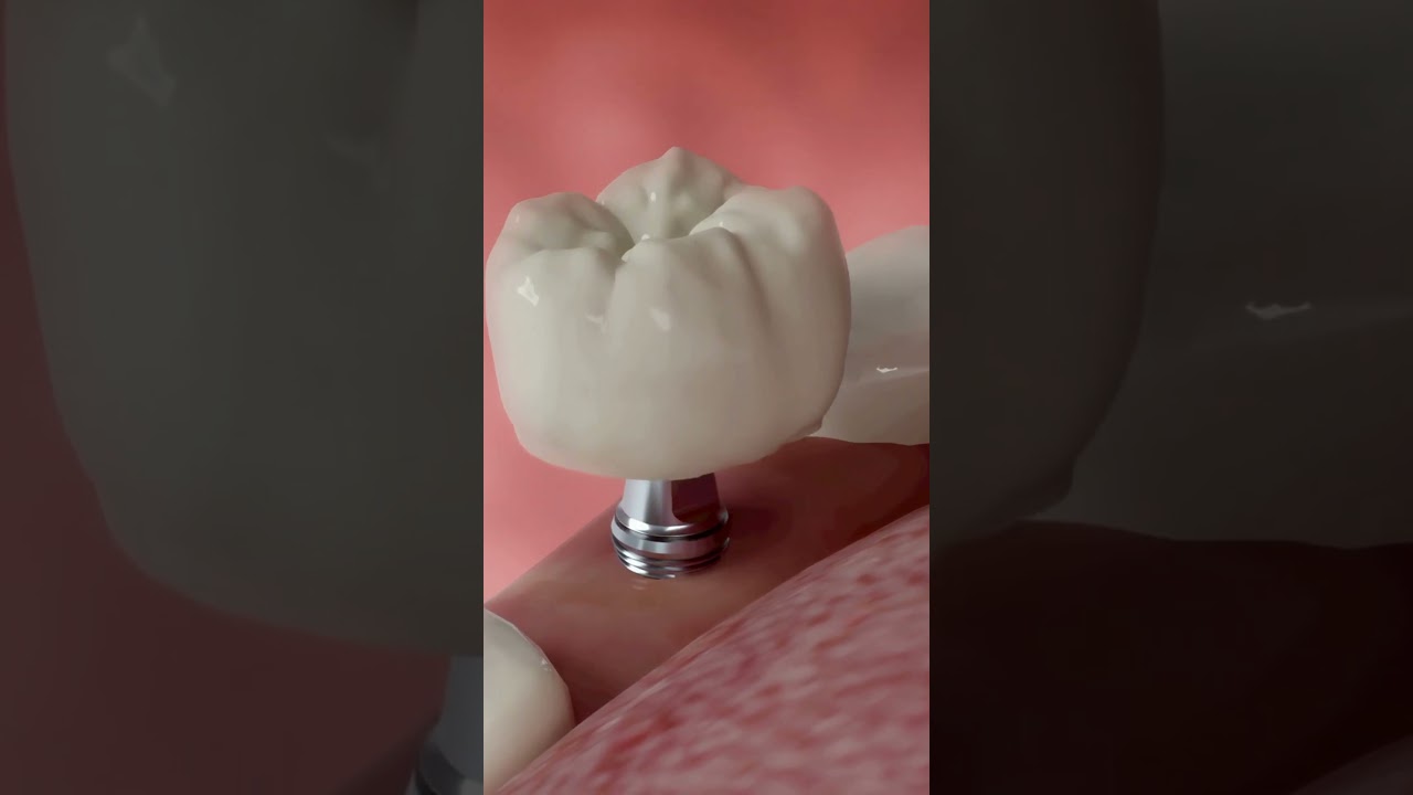 Dental Treatment in Turkey