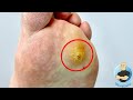 WHAT HAPPENED TO THIS SUPER PAINFUL WART REMOVAL?!