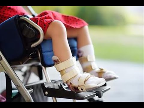 وقاية طريقتان للإصابة بشلل الأطفال وهكذا يمكن الوقاية منه
