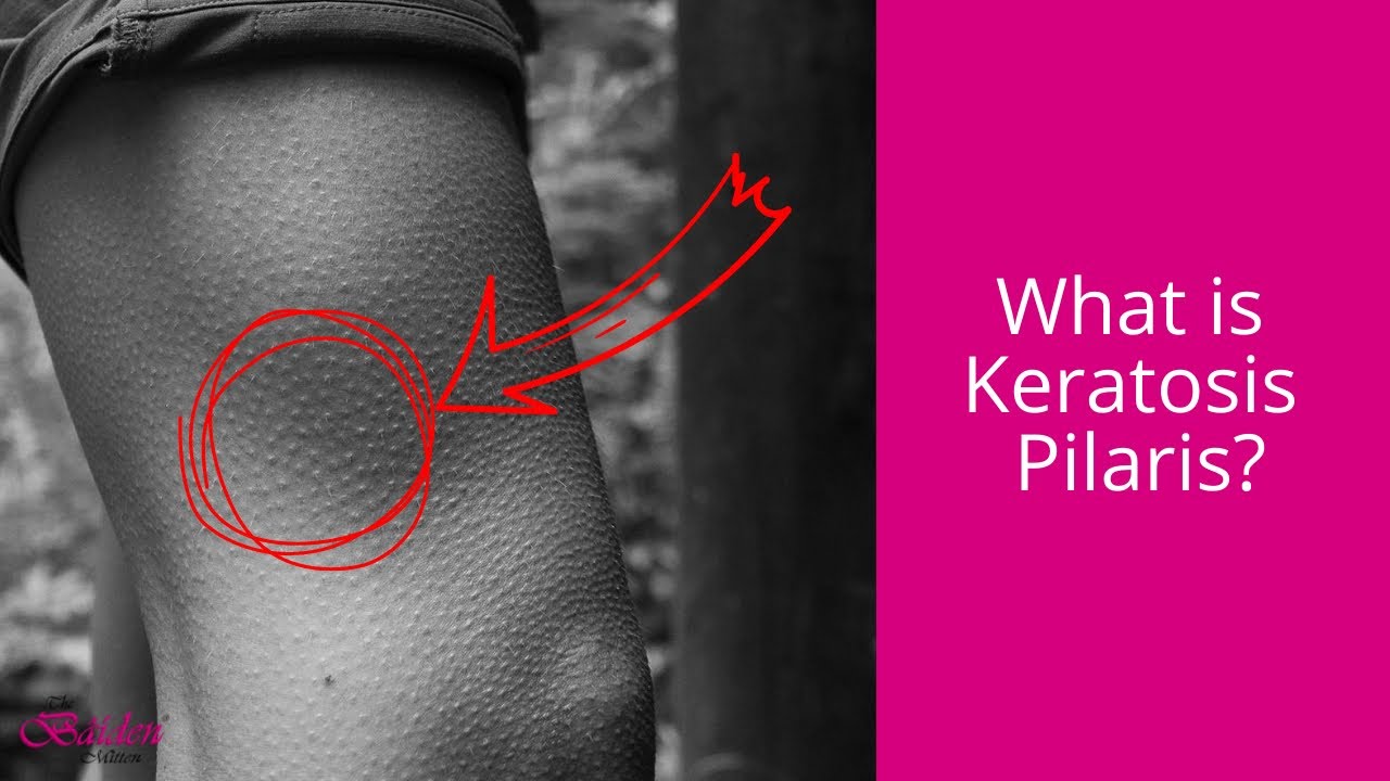 What is Keratosis Pilaris? How to treat it? YouTube