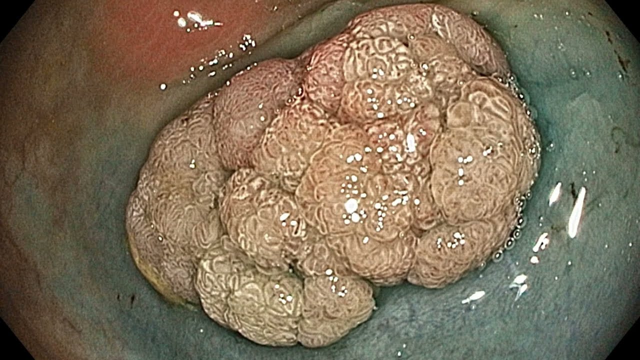 Endoscopic mucosal resection