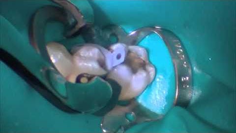 Class II Restoration - Isolation | Dentsply Sirona